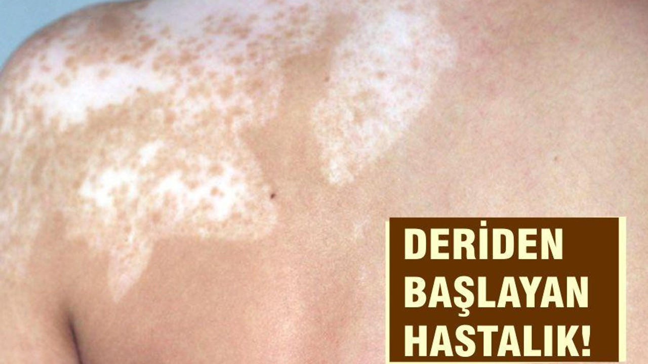 DERİDEN BAŞLAYAN HASTALIK!