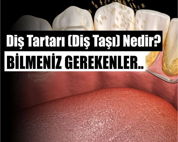 Diş Tartarı (Diş Taşı) Nedir? Zararları Nelerdir Ve Nasıl Önlenir?
